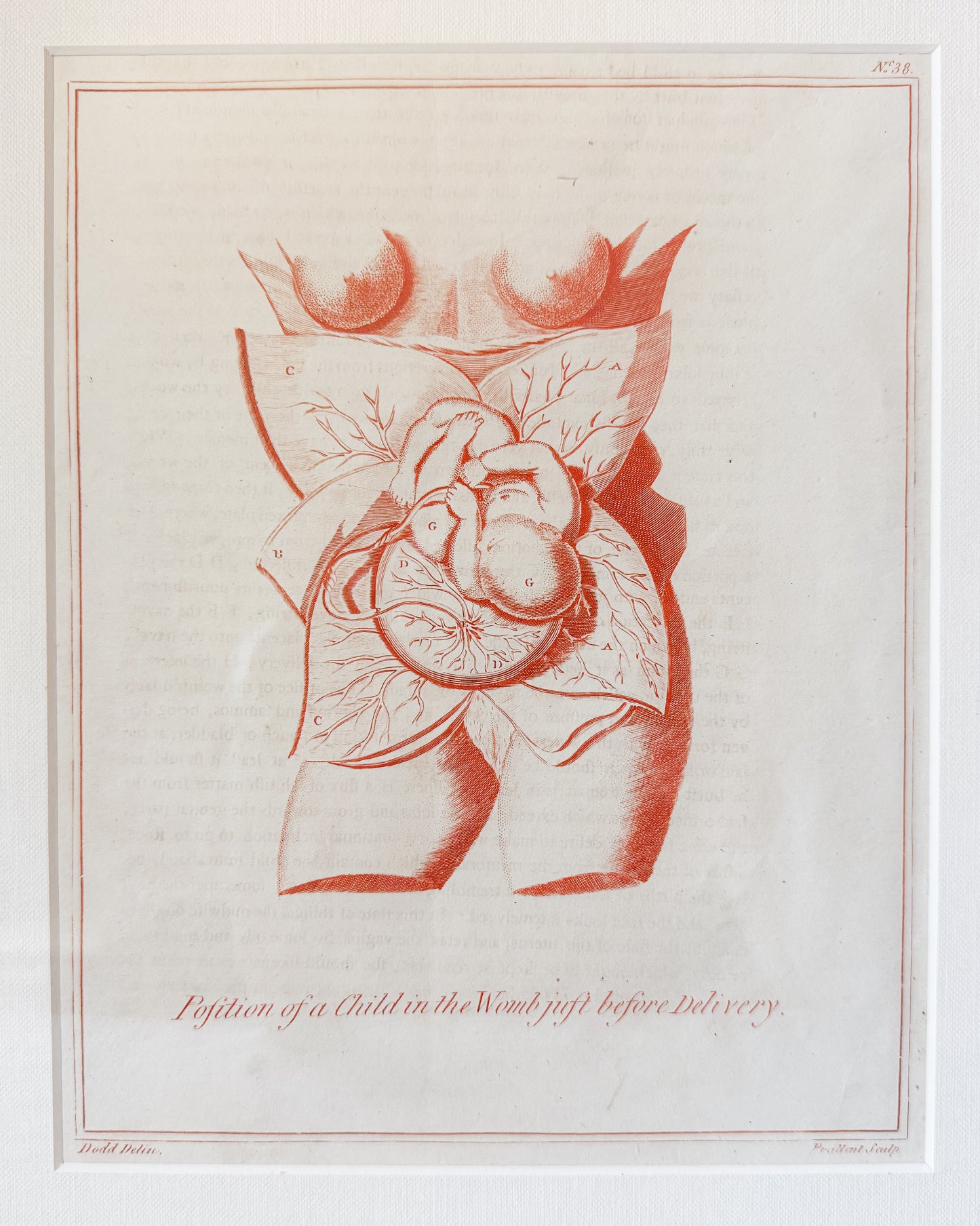 Antique Fetal Anatomy Engraving from Culpeper's English Physician, c1800 - "Position of the Child in the Womb Just Before Delivery" in Custom Frame